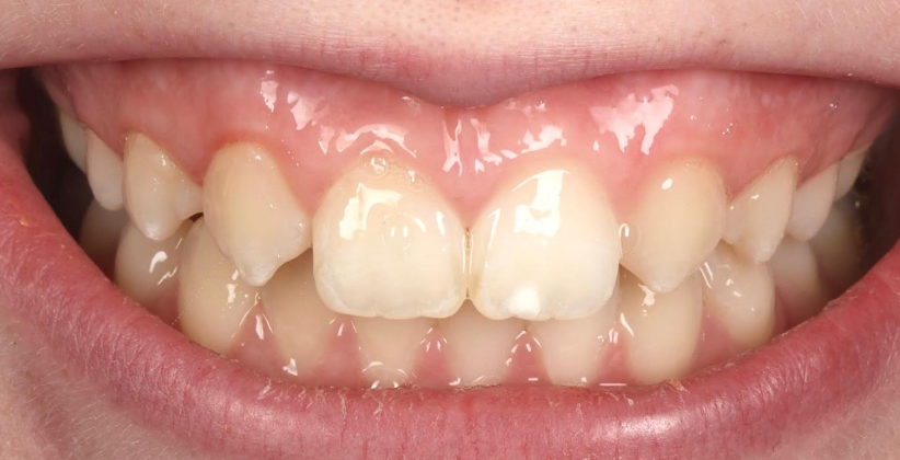 Crown Lengthening before treatment